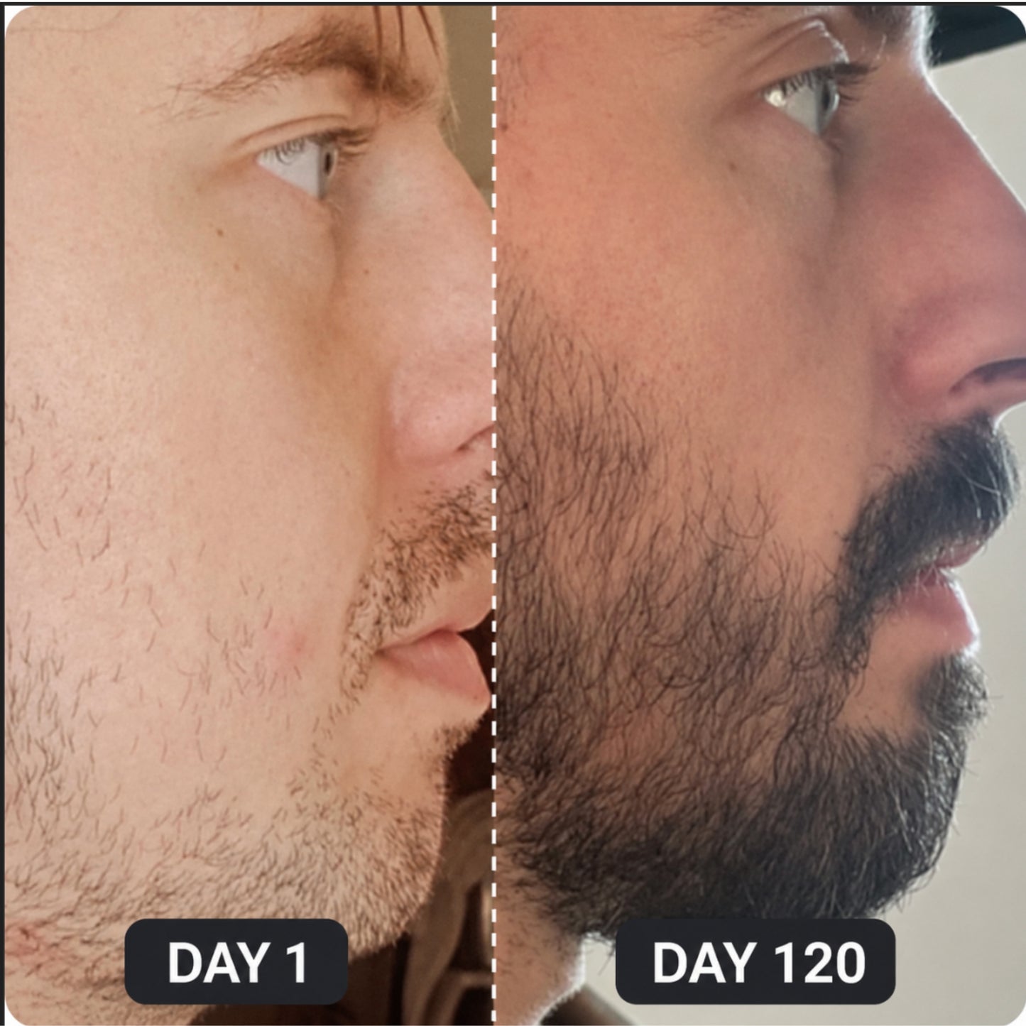 ForgeBeard™ Advanced Beard Therapy Device